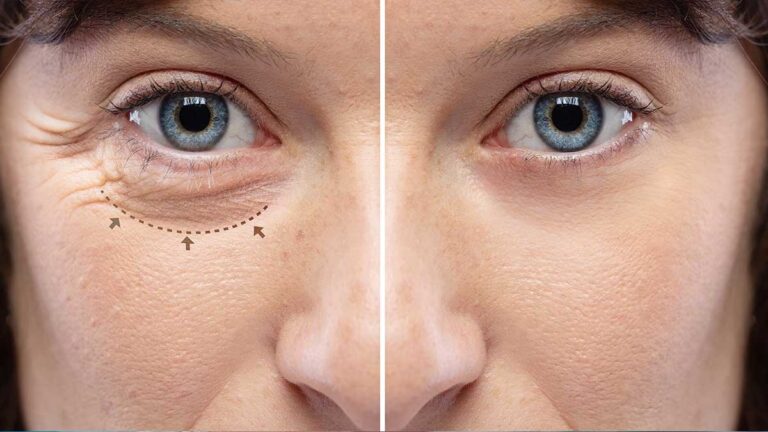 Blepharoplasty Solution for Tired-Looking Eyes in Dubai
